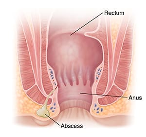 Cross section of rectum and anus, showing abscess near anus.