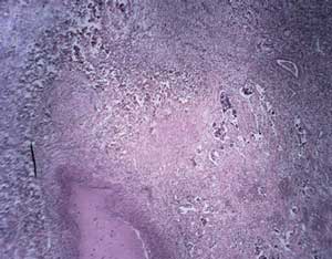 Microscopic image of lung carcinoma. lung carcinoma