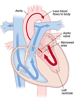Four-chamber view of heart showing subaortic stenosis, with arrows indicate less blood flowing through aorta.