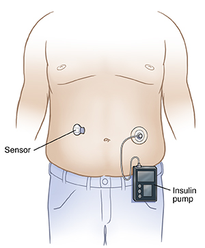 Front view of male torso with continuous glucose monitor sensor on abdomen, attached near one side of navel. Reciever attached to insulin delivery system on other side of navel.