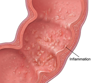 Cross section of colon showing inflammation from ulcerative colitis.