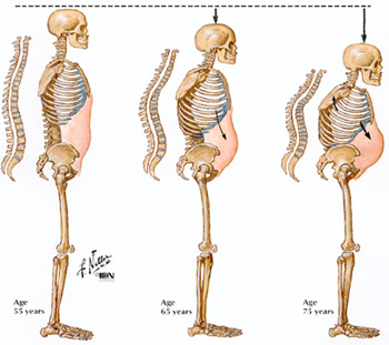 How the Spine Changes with Age Image of three female skeletons illustrating osteoporosis at ages 55, 65, and 75 years.